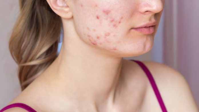 major causes of acne